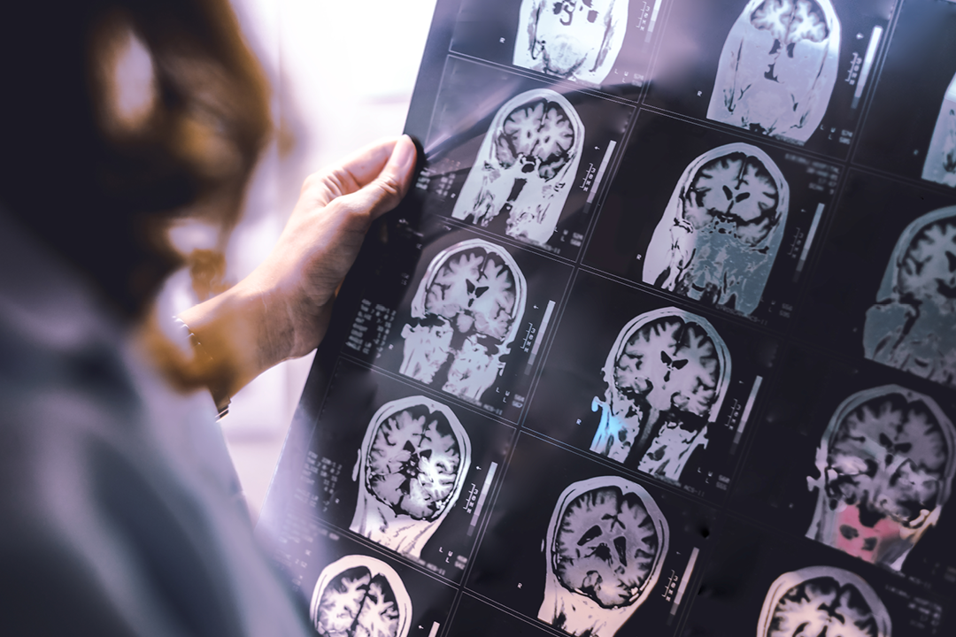 brain atrophy on MRI of Dementia patient