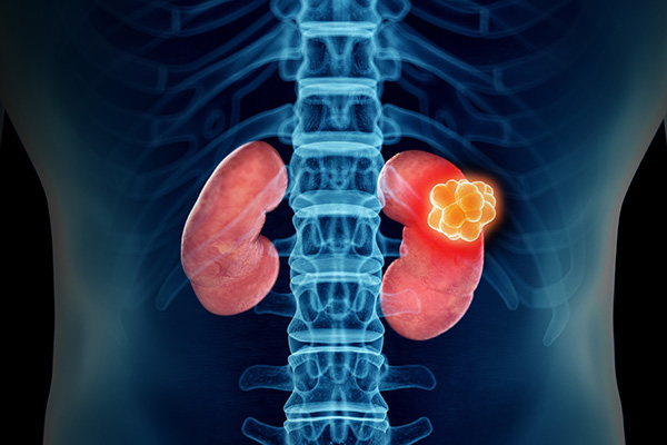 kidney cancer
